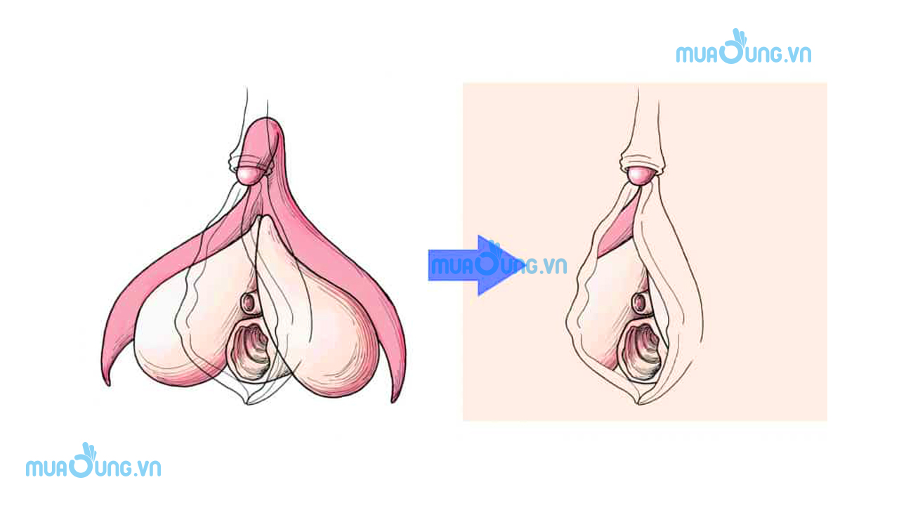 Câu tạo của âm vật (hột le)