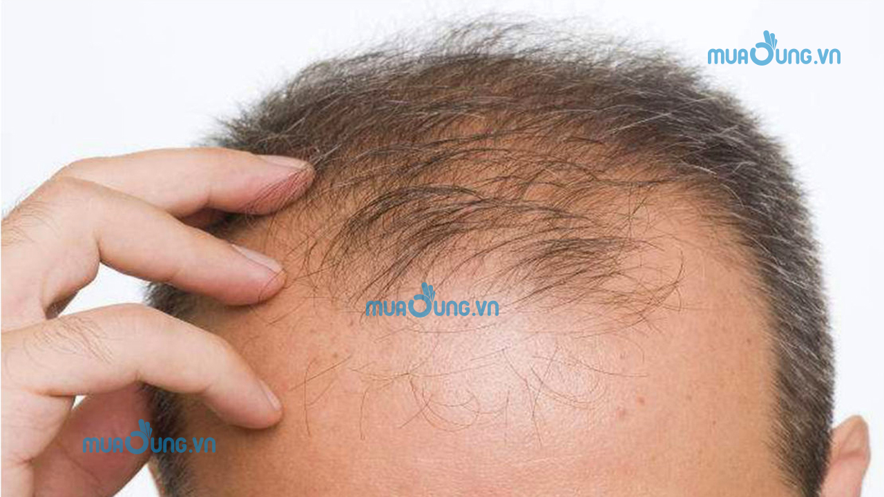 rụng tóc